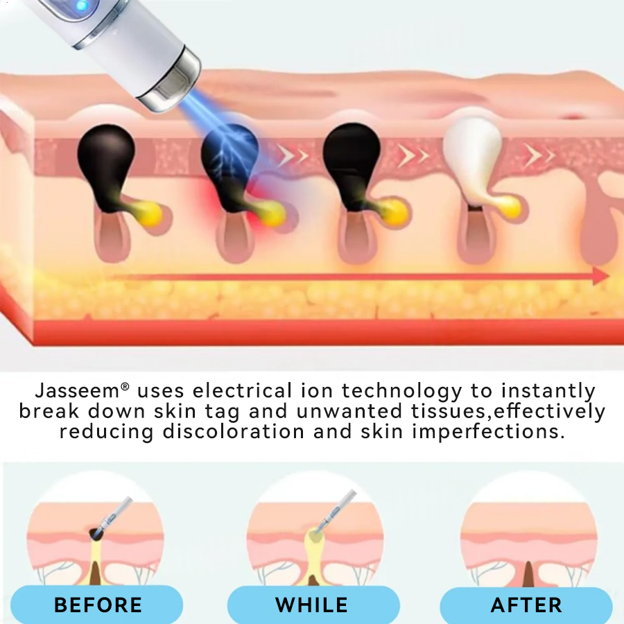 ๐๐๐ฌ๐ฌ๐๐๐ฆยฎ Medical-Grade Laser Pen ๐ (Powered by COโ laser technology โ effectively removes moles, warts, skin tags, pigmentation marks, and other skin imperfections)๐