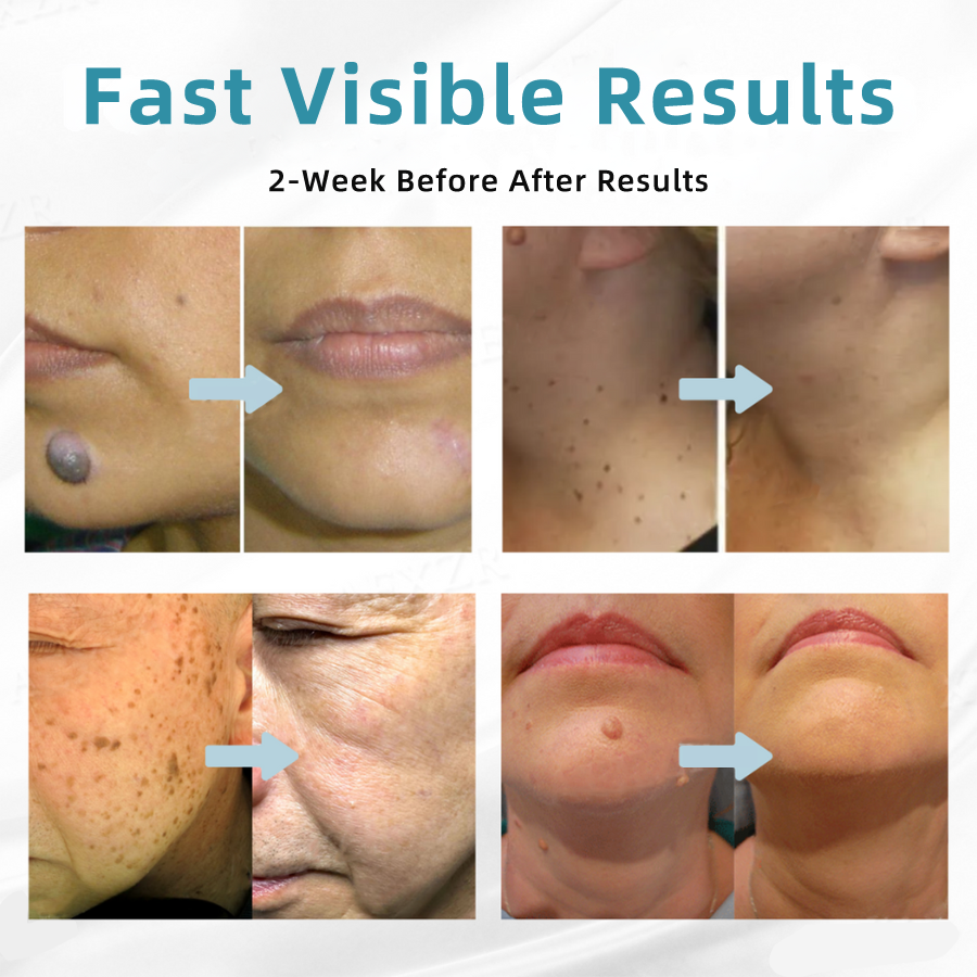 ๐๐๐ฌ๐ฌ๐๐๐ฆยฎ Medical-Grade Laser Pen ๐ (Powered by COโ laser technology โ effectively removes moles, warts, skin tags, pigmentation marks, and other skin imperfections)๐