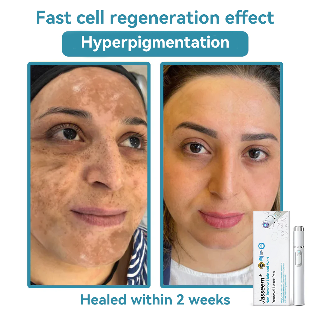 ๐๐๐ฌ๐ฌ๐๐๐ฆยฎ Medical-Grade Laser Pen ๐ (Powered by COโ laser technology โ effectively removes moles, warts, skin tags, pigmentation marks, and other skin imperfections)๐