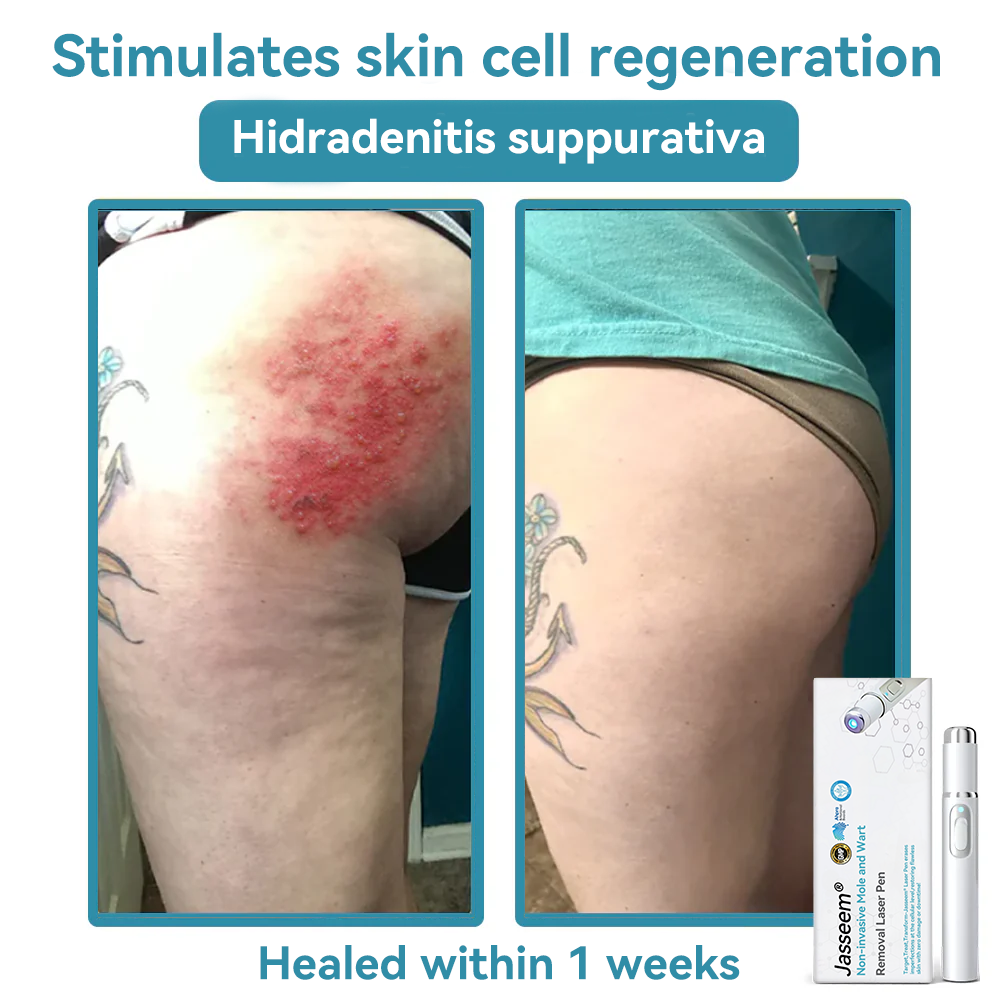 ๐๐๐ฌ๐ฌ๐๐๐ฆยฎ Medical-Grade Laser Pen ๐ (Powered by COโ laser technology โ effectively removes moles, warts, skin tags, pigmentation marks, and other skin imperfections)๐