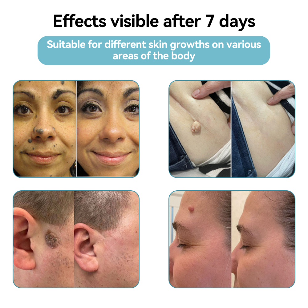 ๐๐๐ฌ๐ฌ๐๐๐ฆยฎ Medical-Grade Laser Pen ๐ (Powered by COโ laser technology โ effectively removes moles, warts, skin tags, pigmentation marks, and other skin imperfections)๐