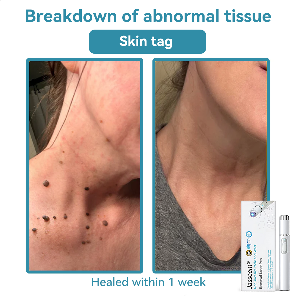 ๐๐๐ฌ๐ฌ๐๐๐ฆยฎ Medical-Grade Laser Pen ๐ (Powered by COโ laser technology โ effectively removes moles, warts, skin tags, pigmentation marks, and other skin imperfections)๐