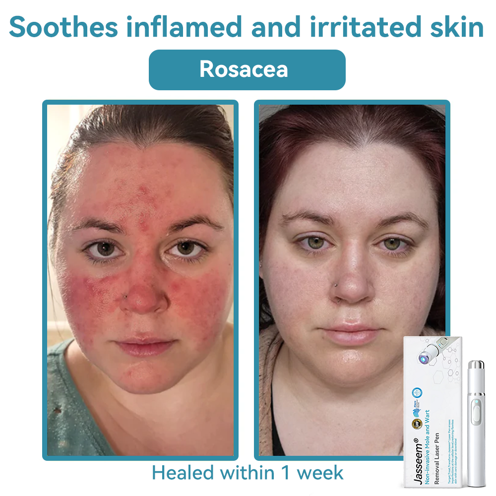๐๐๐ฌ๐ฌ๐๐๐ฆยฎ Medical-Grade Laser Pen ๐ (Powered by COโ laser technology โ effectively removes moles, warts, skin tags, pigmentation marks, and other skin imperfections)๐