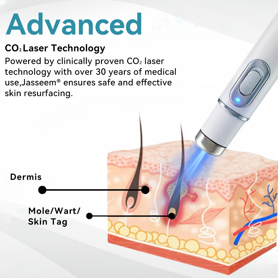 ๐๐๐ฌ๐ฌ๐๐๐ฆยฎ Medical-Grade Laser Pen ๐ (Powered by COโ laser technology โ effectively removes moles, warts, skin tags, pigmentation marks, and other skin imperfections)๐